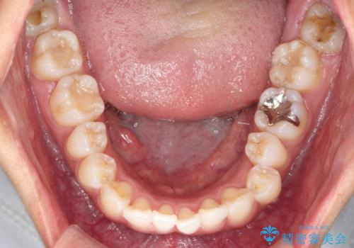 出っ歯感のある前歯を治したい、抜歯をしないマウスピース矯正の治療前