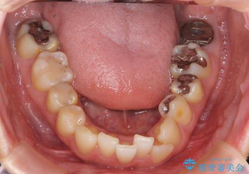 [ マウスピース矯正 ]  歯並びのずれが気になるの治療前