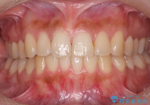 マウスピース矯正では難しい治療にも対応します 歯を抜かない矯正の治療後