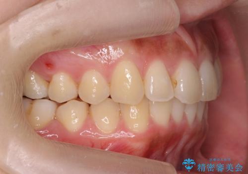 マウスピース矯正では難しい治療にも対応します　歯を抜かない矯正の治療後