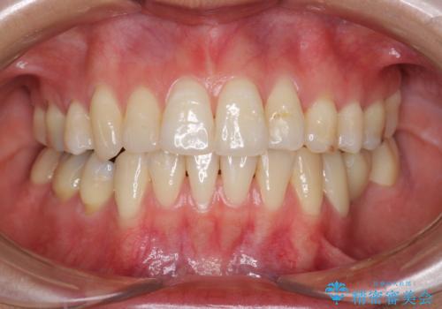 親知らずを生かした矯正の症例 治療後
