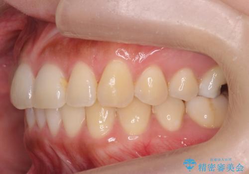 マウスピース矯正では難しい治療にも対応します 歯を抜かない矯正の治療後