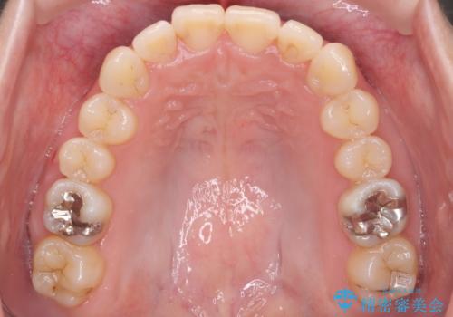 マウスピース矯正では難しい治療にも対応します 歯を抜かない矯正の治療後