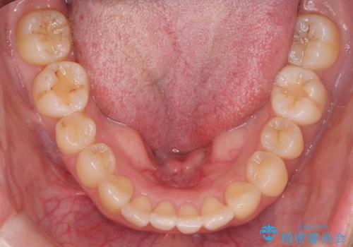 マウスピース矯正では難しい治療にも対応します　歯を抜かない矯正の治療後