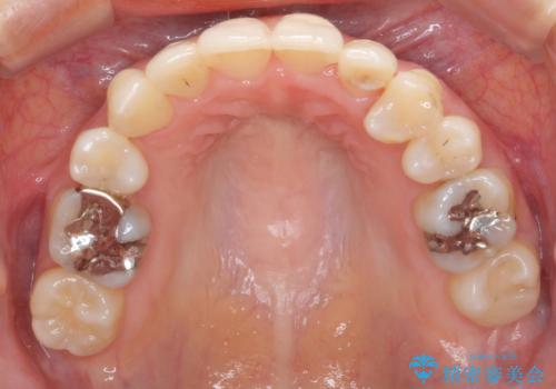 親知らずを生かした矯正の治療後