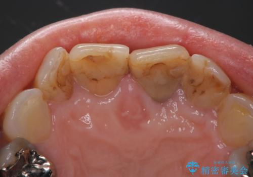 前歯の着色が気になる(失活歯)の治療前