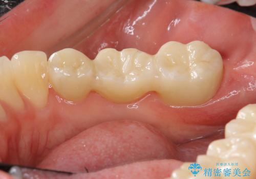 奥歯を抜歯して白いブリッジにの治療後