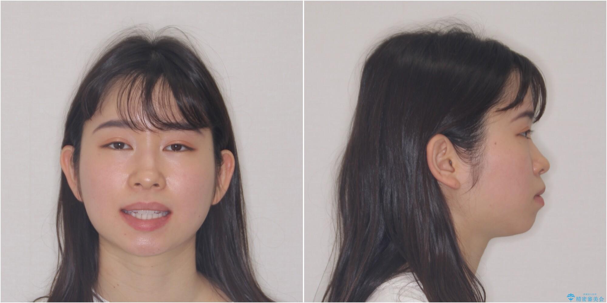 【モニター】口が閉じにくい 膨らんだ口元を抜歯矯正ですっきりとの治療前(顔貌)