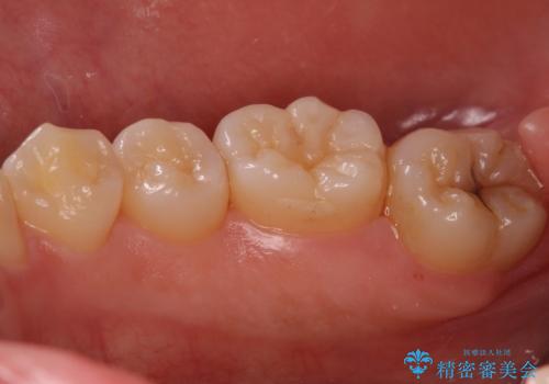 奥歯の深い黒ずみ　セラミックインレーでの治療