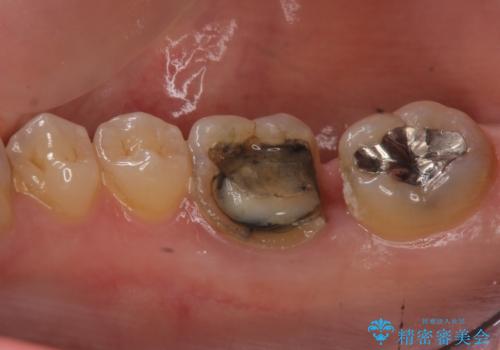 銀歯が取れた セラミックでのやり替えの治療前