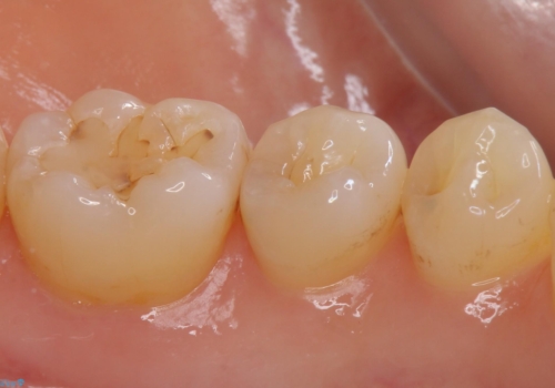 奥歯の詰め物をやり替えたい　セラミックインレーでの治療の治療前