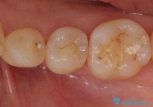 奥歯の詰め物をやり替えたい　セラミックインレーでの治療の症例 治療前