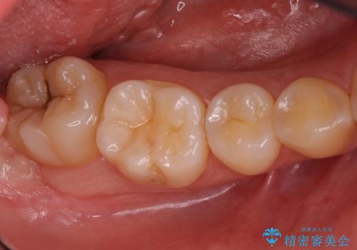 奥歯の深い黒ずみ　セラミックインレーでの治療の症例 治療前