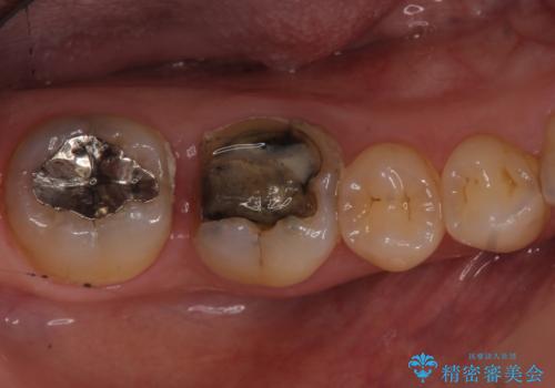 銀歯が取れた　セラミックでのやり替えの症例 治療前