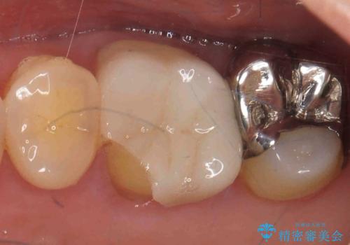 割れた被せ物を作りなおしたいの治療前