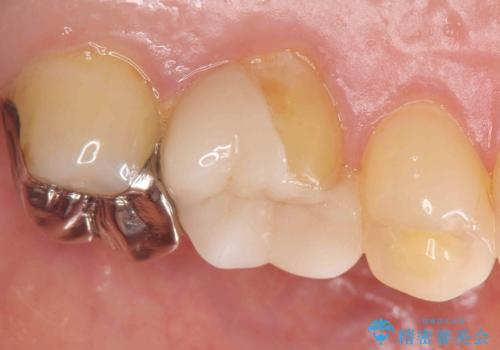 割れた被せ物を作りなおしたい