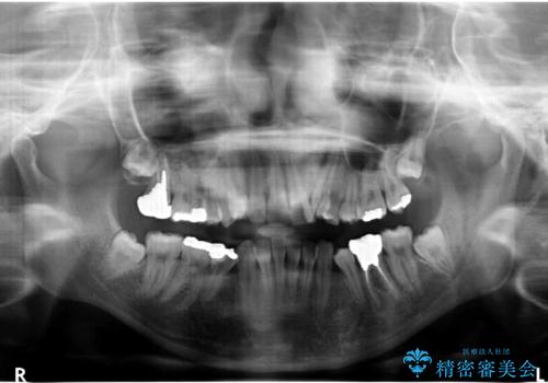 親知らずを生かした矯正の治療前
