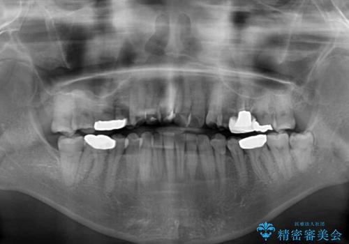 前歯の後戻り インビザラインでの再矯正治療の治療前