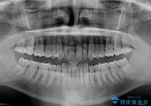 【モニター】前歯のデコボコを治したい インビザライン矯正治療の治療前