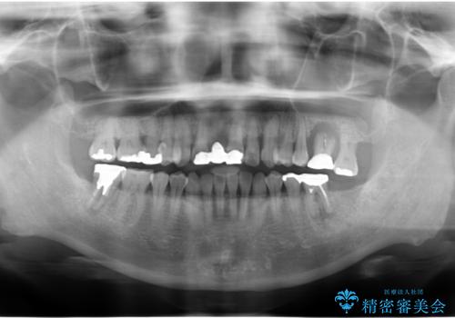 歯周病に対する全体治療の治療前