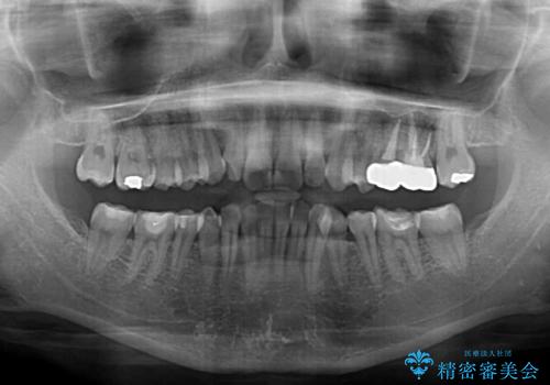 【モニター】隠れている下顎の前歯をインビザラインで改善の治療前