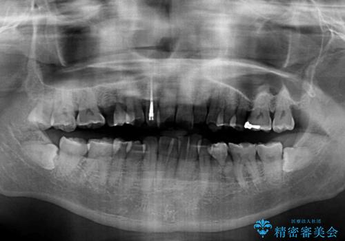 左右に骨格がずれて咬みにくい ワイヤー装置による抜歯矯正の治療前