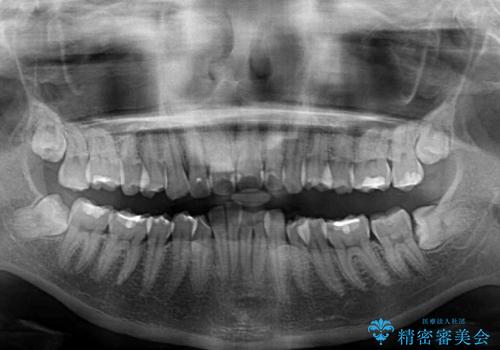 深い咬み合わせと前歯のデコボコ インビザラインによる矯正治療の治療前