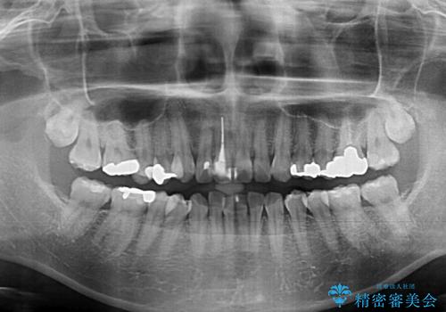 【モニター】前歯のデコボコを治したい インビザラインを用いた矯正治療の治療前