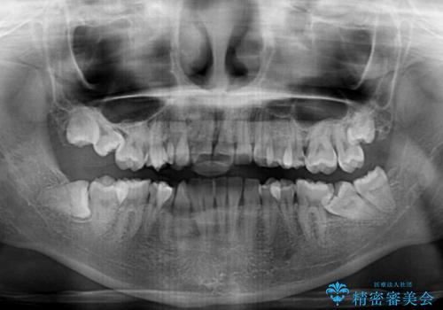 重度叢生と埋もれた奥歯　8本を抜歯したワイヤー矯正の治療前