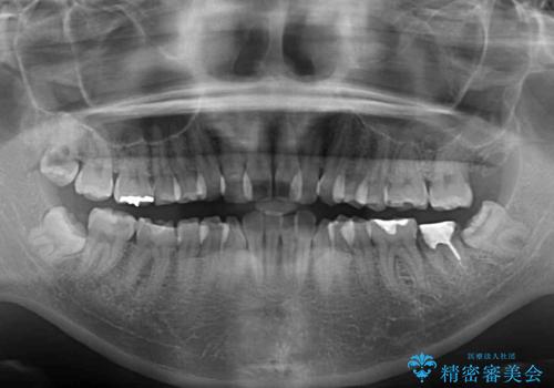 デコボコと膨らんだ口元 ハーフリンガルによる抜歯矯正とインプラント補綴治療の治療前