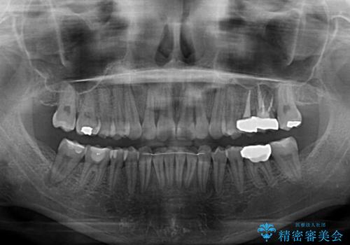 【モニター】隠れている下顎の前歯をインビザラインで改善の治療後