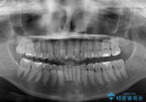 深い咬み合わせと前歯のデコボコ インビザラインによる矯正治療の治療後
