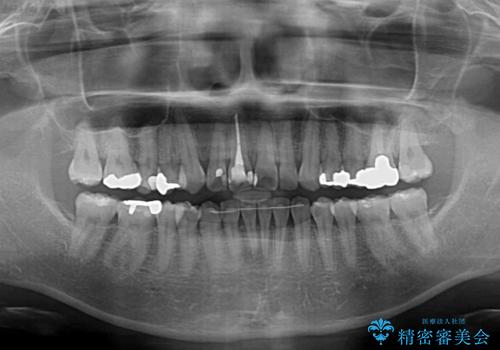 【モニター】前歯のデコボコを治したい インビザラインを用いた矯正治療の治療後