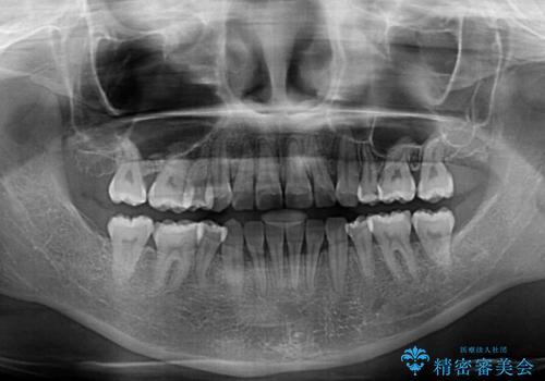 重度叢生と埋もれた奥歯　8本を抜歯したワイヤー矯正の治療後