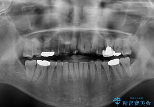 前歯の後戻り インビザラインでの再矯正治療の治療後