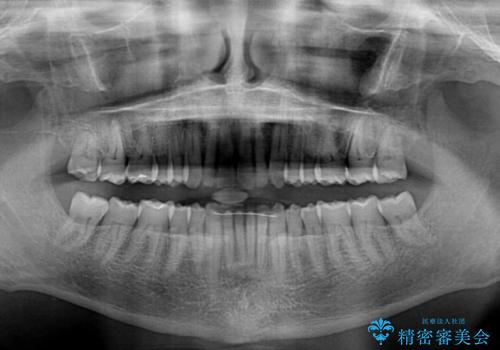 【モニター】前歯のデコボコを治したい インビザライン矯正治療の治療後
