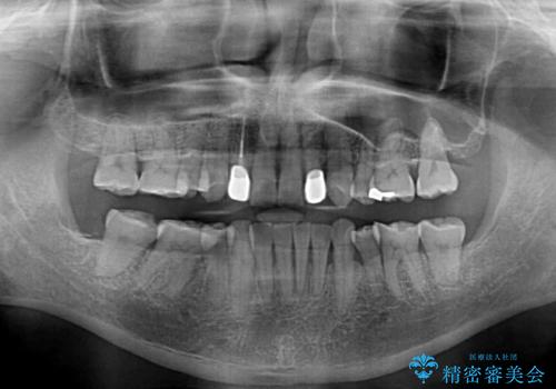 左右に骨格がずれて咬みにくい　ワイヤー装置による抜歯矯正の治療後