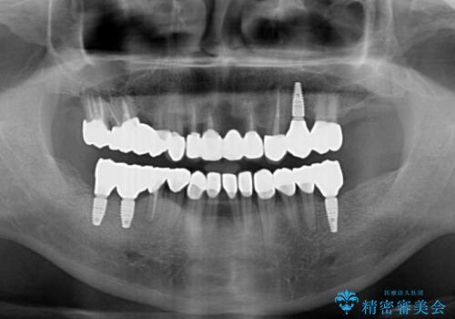 欠損と虫歯だらけの口の中 真っ白なセラミック治療の治療後