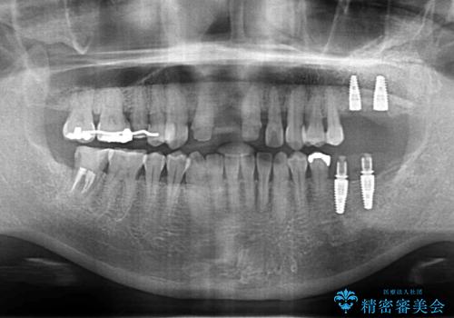 歯周病に対する全体治療の治療中
