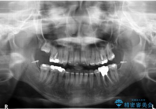 親知らずを生かした矯正の治療中