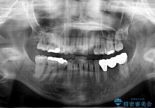 親知らずを生かした矯正の治療後