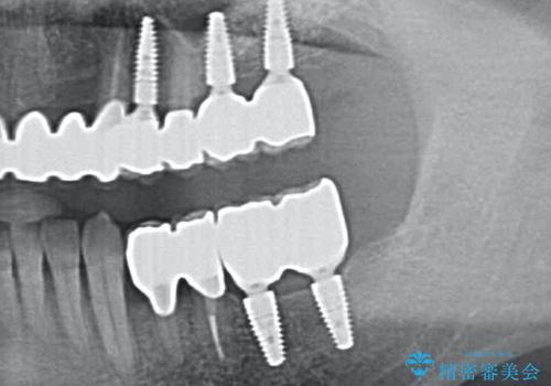 [ 重度歯周病 ] 骨造成・インプラント治療による咬合機能の回復