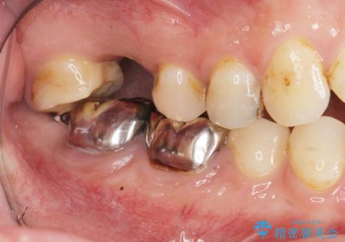 「 セラミック治療 」奥歯を白くしたいの治療前