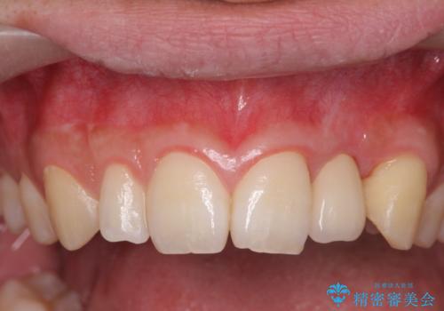 前歯部 インプラント治療の治療後