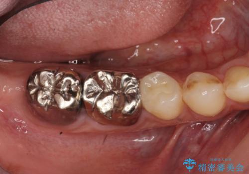 「 セラミック治療 」奥歯を白くしたいの治療前