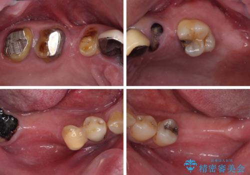 欠損と虫歯だらけの口の中 真っ白なセラミック治療の治療前