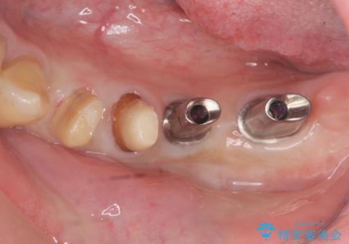 [ 重度歯周病 ] 骨造成・インプラント治療による咬合機能の回復の治療中