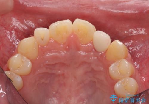 前歯部 インプラント治療の治療後