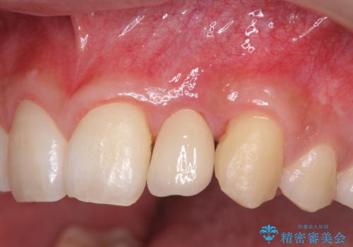 前歯部 インプラント治療の症例 治療後