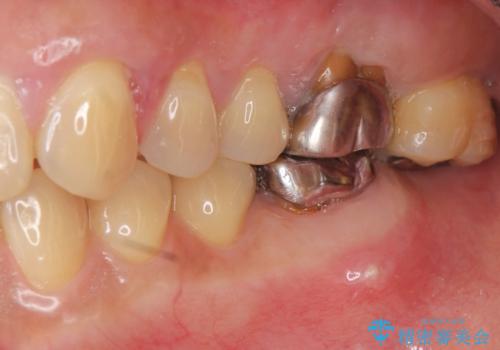 歯周病に対する全体治療の治療前